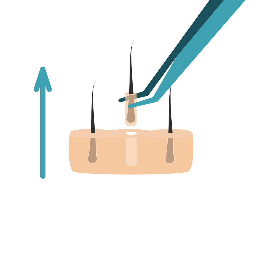 haartransplantatie fase 2