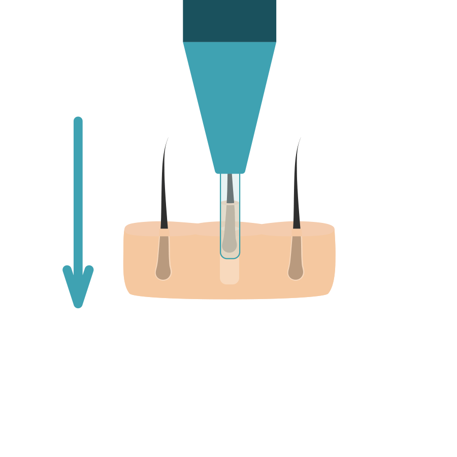 haartransplantatie fase 4