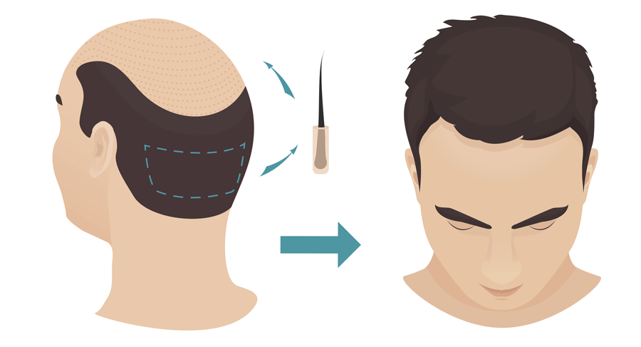 haartransplantatie resultaat