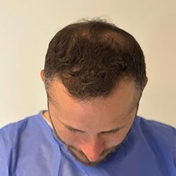 man kalend voorbeeld haartransplantatie